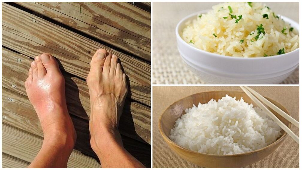 Za bolnike s protinom se priporoča dieta na osnovi riža. 